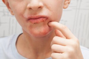 Read more about the article All You Need To Know About Herpes