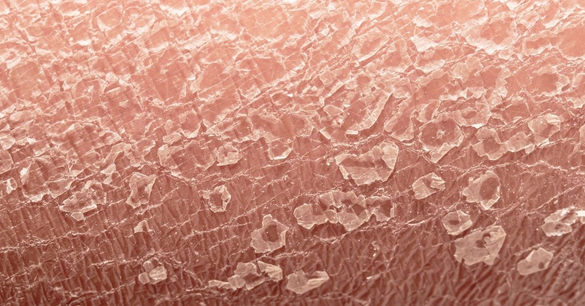 Read more about the article Everything You Need to Know About Psoriasis