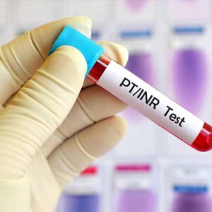 Partial Thromboplastin Time & Prothrombin Test (PTT/PT)