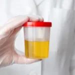 Urine ETG